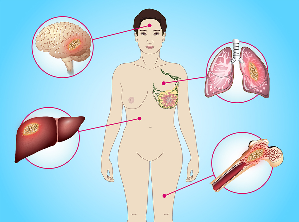 <b>Metastatic breast cancer</b> is cancer that has spread from the breast to other areas of the body. Here's what you need to know about <b>symptoms</b>, <b>diagnosis</b>, and <b>treatment options</b>.