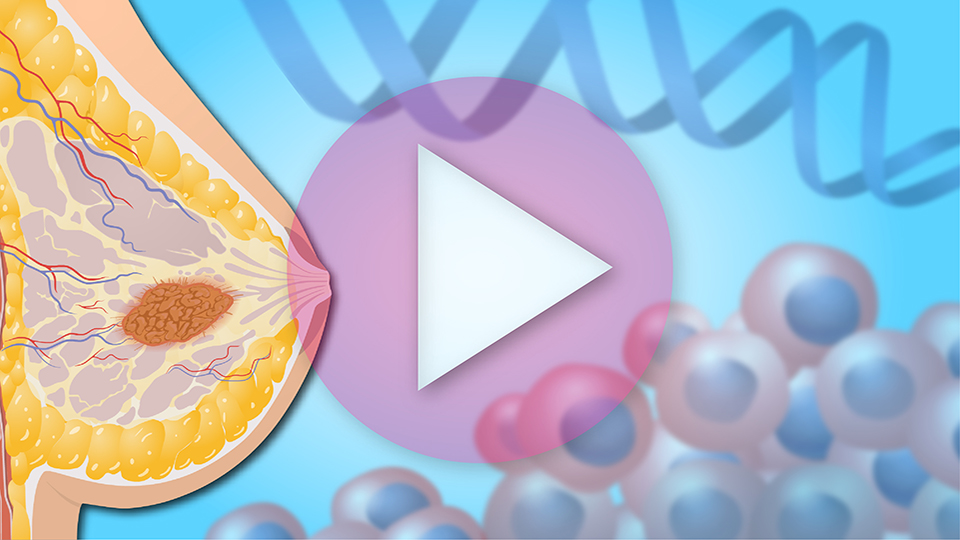 Animation - Understanding Breast Cancer