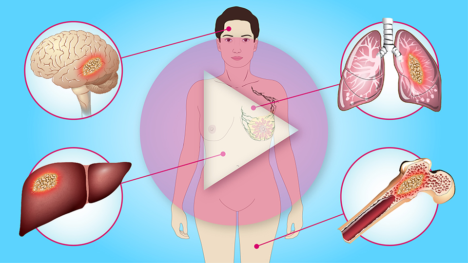 Understanding Metastatic Breast Cancer