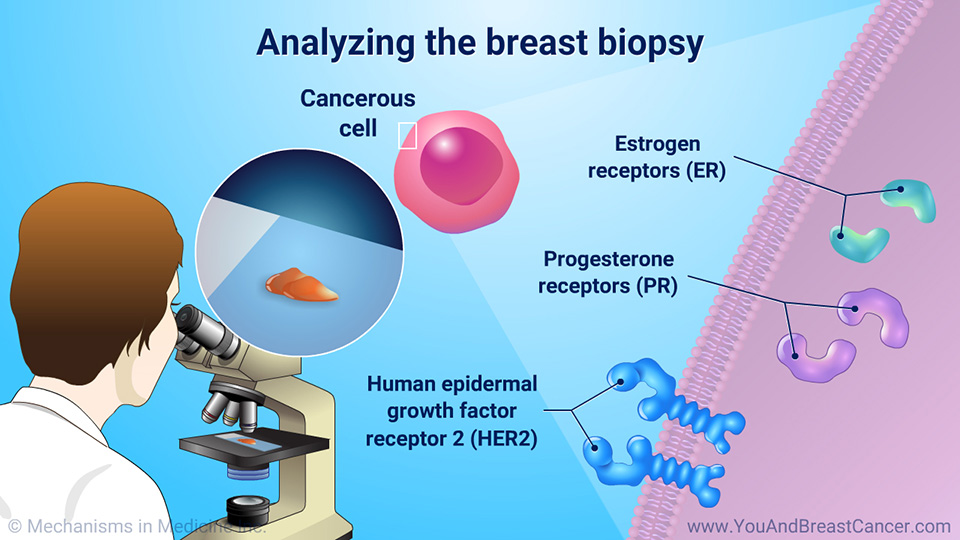 Analyzing the breast biopsy