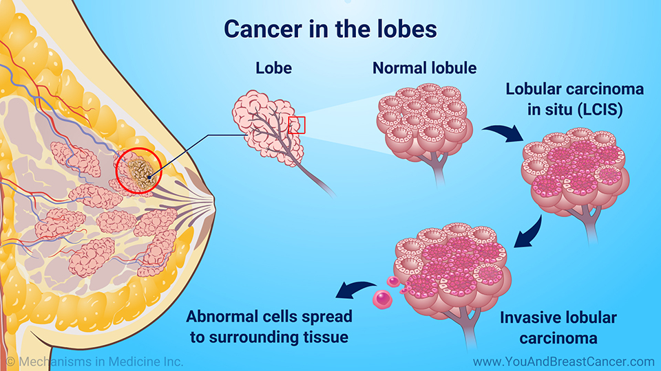 Cancer in the lobes