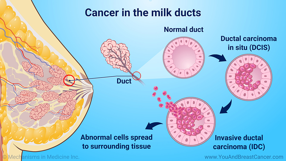 Cancer in the milk ducts