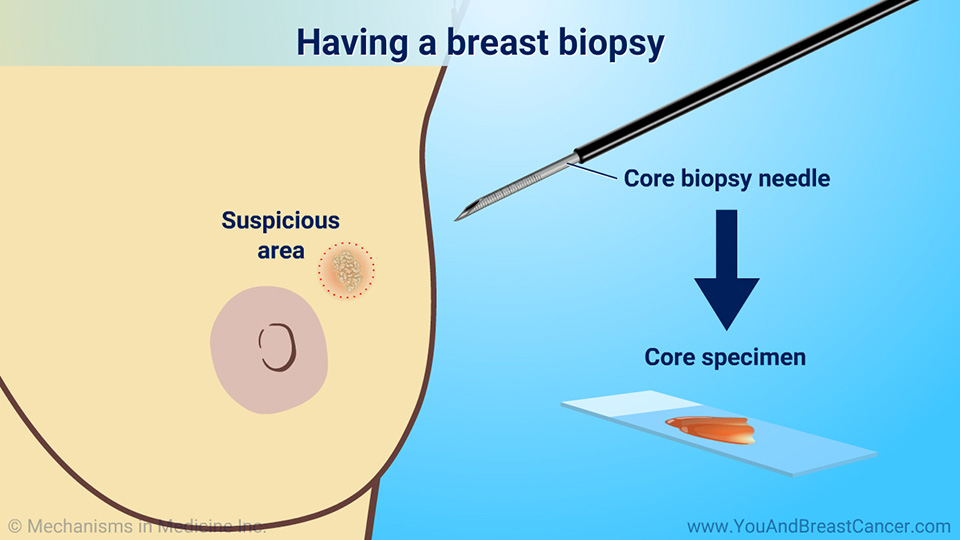 Having a breast biopsy