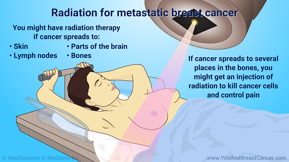 Radiation for metastatic breast cancer