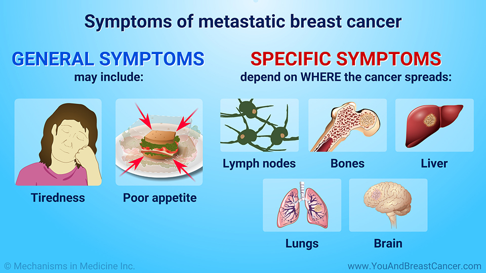 Symptoms of metastatic breast cancer