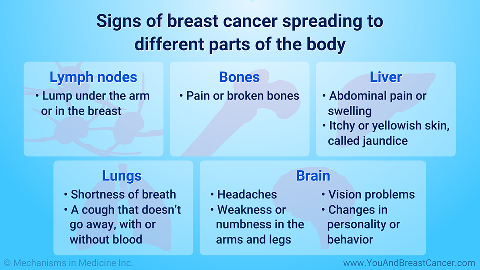 Symptoms of metastatic breast cancer