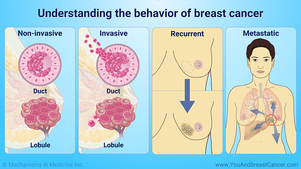 Understanding the behaviour of breast cancer