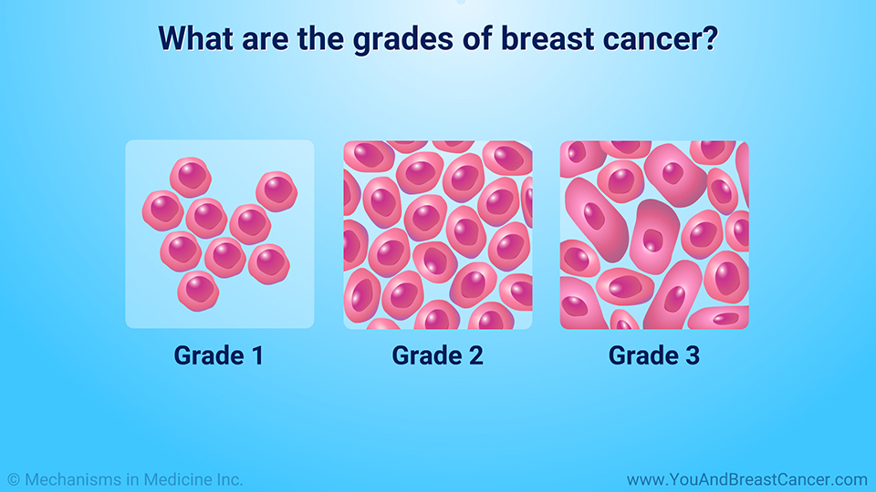 What are the stages and grades of breast cancer?