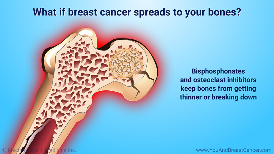What if breast cancer spreads to your bones?
