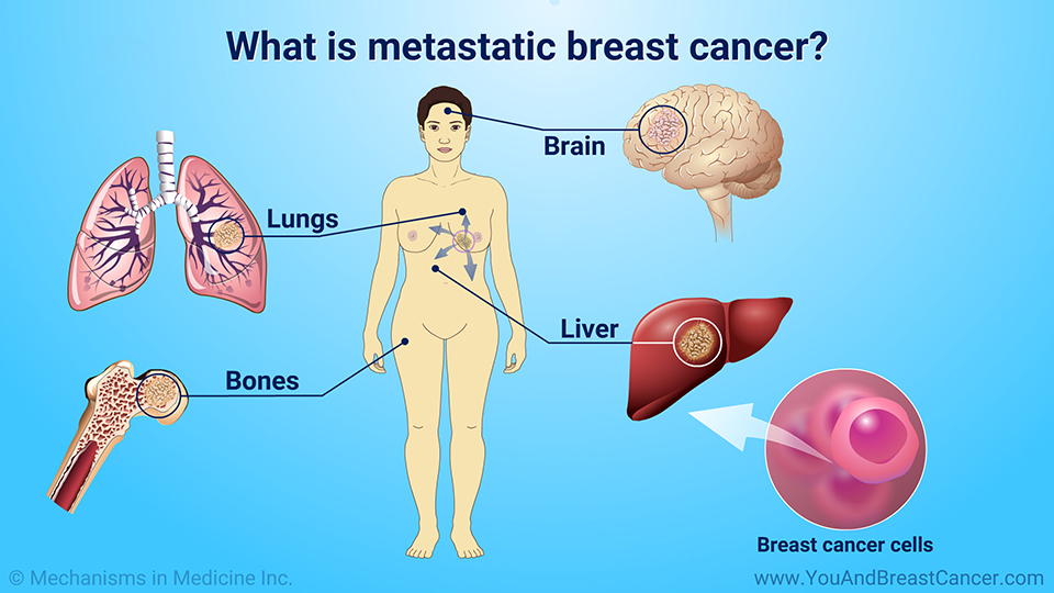 What is metastatic breast cancer?