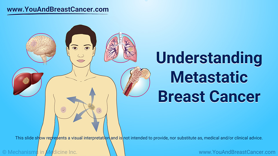 Slide Show - Understanding Metastatic Breast Cancer